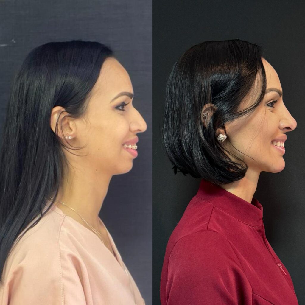 Harmonização com PMMA promove a inclusão social e bem-estar