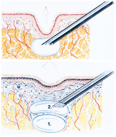 ARTECOLL: A LONG-LASTING INJECTABLE WRINKLE FILLER MATERIAL: REPORT OF A CONTROLLED, RANDOMIZED, MULTICENTER CLINICAL TRIAL OF 251 SUBJECTS