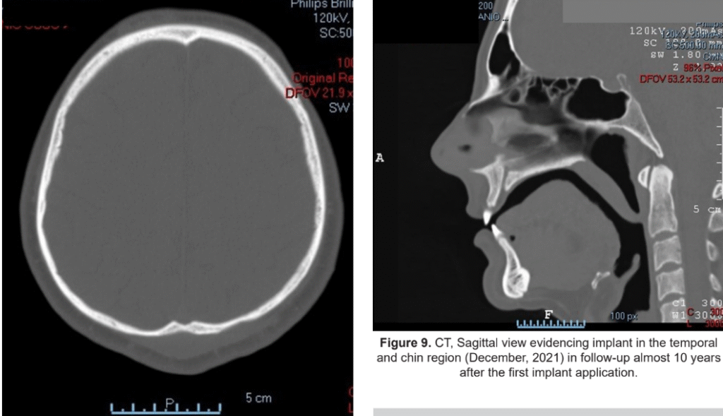 CORRECTION OF CRANIAL ASYMMETRY WITH PMMA: CASE REPORT