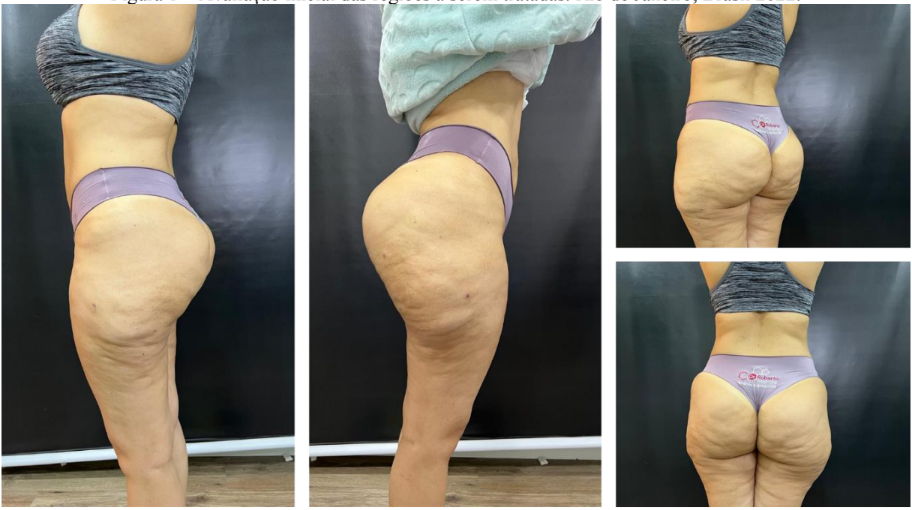 INJEÇÕES DE POLIMETILMETACRILATO PARA REMODELAÇÃO GLÚTEA E SUBCISÃO DE CELULITES: RELATO DE CASO