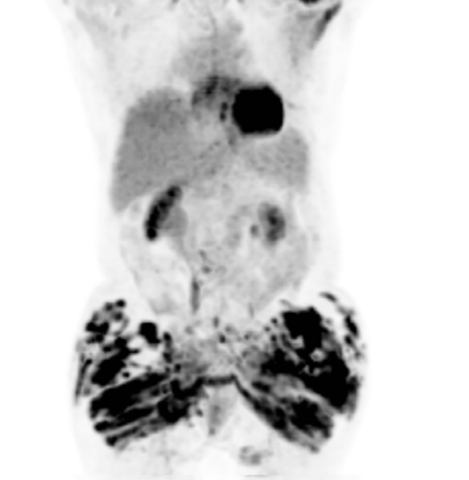 RELATOS DE CASOS DE HIPERCALCEMIA E DOENÇA RENAL CRÔNICA DEVIDAS A INJEÇÕES