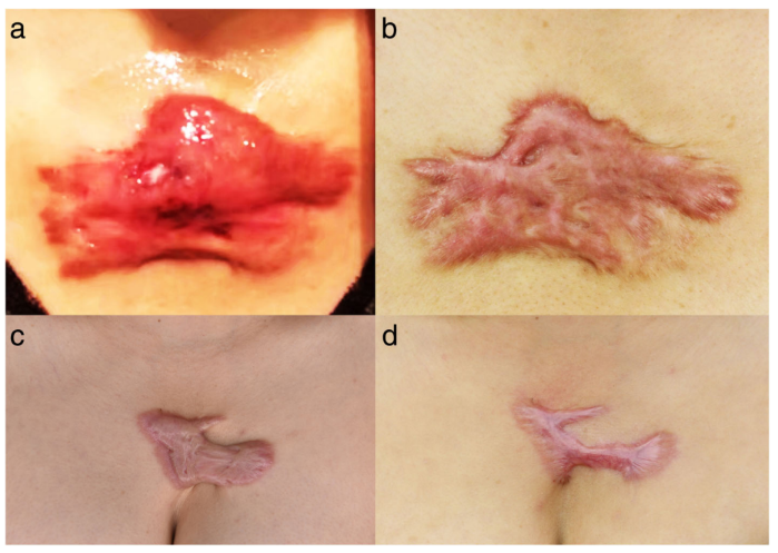 THE 1470 NM DIODE LASER WITH AN INTRALESIONAL FIBER DEVICE: A PROPOSED SOLUTION FOR THE TREATMENT OF INFLAMED AND INFECTED KELOIDS